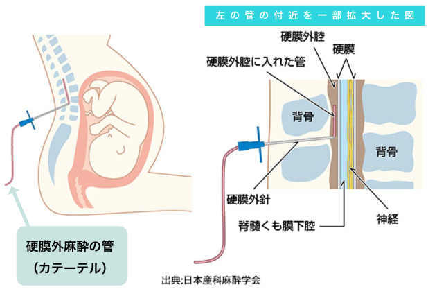 無痛分娩について
